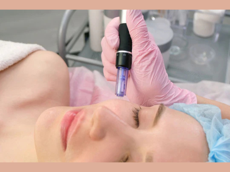 Cure de 3 séances de microneedling